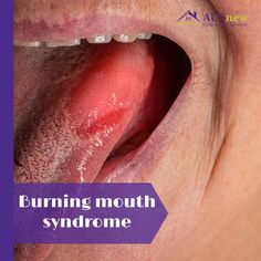 Burned My Tongue, Burnt Mouth Remedy, Burnt Tongue Syndrome, Burning Mouth Symptoms, Burning Mouth, Sore Mouth And Tongue, Dry Mouth Sore Tongue, Roof Of Mouth Sore, How To Soothe A Burnt Tongue