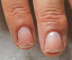 Cracks In Nails, Cracked Nail Bed, Cracked Fingernails, Cracked Nail Bed Repair, How To Fix Cracked Natural Nail, Repair Split Nail, Skin Under Nails Peeling, Nail Remedies, Cracked Nails