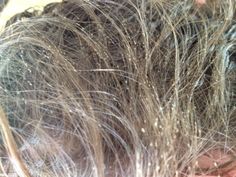 This is a very bad infestation of head lice -nits on every hair! To remove these I used the terminator comb with enzyme mousse Mites In Hair, Nits In Hair Pictures, Severe Lice Infestation, How To Remove Nits From Hair, Lice Hair Removal, How To Get Rid Of Lice And Nits Fast, Photos Of Lice, Natural Remedies For Lice And Nits, Best Way To Get Rid Of Lice And Nits