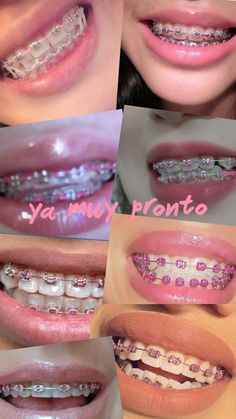 Perfect Teeth Braces, Braces Tips, Pretty Teeth, Kids Braces, Getting Braces, Cute Braces, Dental Braces, Teeth Braces, Perfect Teeth