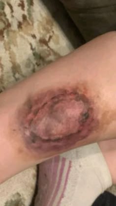 Zombie Bite Tattoo, Bite Mark Tattoo, Zombie Halloween Makeup, Zombie Clothes, Zombie Halloween Costumes, Zombies Books, Mark Tattoo, Zombie Makeup, Zombie Costume