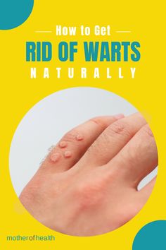 If you are on a mission to figure out how to get rid of warts naturally, here we focus on many different natural treatments for warts that are safe and effective. Also: What Causes Warts? Different Types of Warts How to Get Rid of Warts Naturally with Home Remedies Different Types Of Warts, What Causes Warts, Get Rid Of Pinworms, Types Of Warts, Natural Remedies For Pinworms, Miracle Tree, Get Rid Of Warts, Natural Glowing Skin, Holistic Remedies