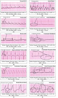 Heart Rhythms Nursing, Difference Between Ecg And Ekg, Cardio Nursing, What Is The Difference Between Ecg And Ekg, Cardiac Medications Affecting Heart Rate, Cardiology Np, Cardiac Dysrhythmias And Ekg Diagram, Ekg Rhythms Nursing, Basic Ekg/ecg Rhythm Chart