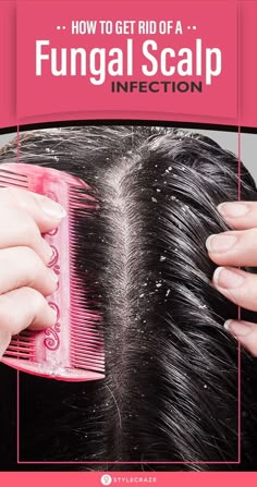 To Get Rid Of Dandruff, Antifungal Shampoo For Humans, Scalp Fungal Infection, Scalp Infection, Smelly Scalp Remedy, Scalp Care For Dandruff, Scalp Breakouts Remedies, How To Get Rid Of Itchy Scalp, Dandruff Remedy Severe