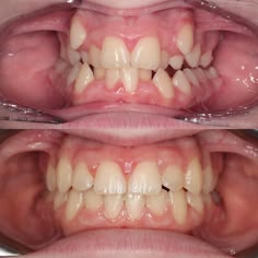 Check out this 15year old female’s transformation! ⠀⠀⠀⠀⠀⠀⠀⠀⠀ Our orthodontics is comprehensive. We don’t just look at aesthetics but functionality too. ⠀⠀⠀⠀⠀⠀⠀⠀⠀ When she came into see Dr.Ng she presented with: -Extremely crowded teeth -Buccally impacted canines -Bilateral crossbite ⠀⠀⠀⠀⠀⠀⠀⠀⠀ After only 15 months of braces she now has: -Improved functionality for chewing -Broader arches -Beautiful straight teeth ⠀⠀⠀⠀⠀⠀⠀⠀⠀ *All accomplished WITHOUT extractions or surgery!* ⠀⠀⠀⠀⠀⠀⠀⠀⠀ If you want t Teeth Wide Open, Jagged Teeth, Teeth Study, Gritted Teeth Reference, Realistic Teeth, Crowded Teeth, Teeth Smile Reference, Crooked Teeth Reference, Teeth Reference