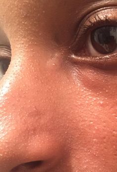 [Skin Concerns] How can i get rid of these tiny bumps on my nose? Ive tried everything Small Bumps On Nose, Bumpy Face, Tiny Bumps, Nose Bumps, Nose Bumps Get Rid Of, How To Get Rid Of Bumps On Nose, How To Get Rid Of Small Bumps On Face, How To Get Rid Of Tiny Bumps On Skin, Skincare For Textured Bumpy Skin