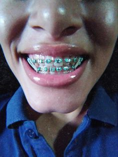 Mint Green Braces Color, Neon Green Braces Color, Mint Blue Braces, Orange And Green Braces, Seafoam Green Braces, Green And Purple Braces, Green And Yellow Braces, Lime Green And Pink Braces, Jade Green Braces