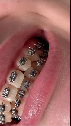 Mouth Clip, Teeth Clips, Braces Colours Aesthetic, Cute Silver Braces, Silver Braces On Yellow Teeth, Braces On Teeth, Cool Braces, Braces Vision Board, Real Braces