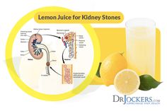 Kidney Stone Cleanse, Juices For Kidney Stone, Kidney Stone Tea, How To Break A Kidney Stone Naturally, Understanding Kidney Stone Formation, How To Help Pass A Kidney Stone, How To Dissolve A Kidney Stone, Kidney Stone Types, Help Passing A Kidney Stone