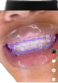 Lilac Purple Braces, Purple And Black Braces, Blue And Purple Braces Teeth, Braces Aesthetic Purple, Pink And Purple Braces Teeth, Purple Grillz, Neon Purple Braces, Violet Purple Braces, Grills For Girls Teeth