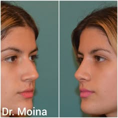 Mini Nose Job, Short Nose Rhinoplasty, Small Nose Rhinoplasty, Wide Nose Rhinoplasty, Roman Nose Before And After, Bulbous Nose Before And After, Wide Bridge Nose Rhinoplasty, Wide Nostrils Rhinoplasty, Rhinoplasty Chicago