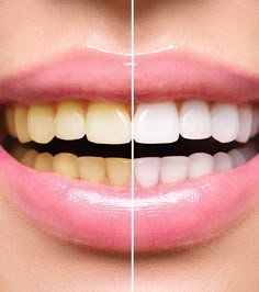 Tired of living with a yellow smile? At Cosmetic Dental Texas, we have got you covered! https://cosmeticdentaltexas.com/houston-services/teeth-whitening/ Natural Yellow Teeth, Get Rid Of Yellow Teeth, Yellow Teeth Aesthetic, Yellow Teeth Remedy, Yellow Teeth To White, Bright Teeth, Yellow Teeth Smile, Teeth Yellow, Memes About Teeth