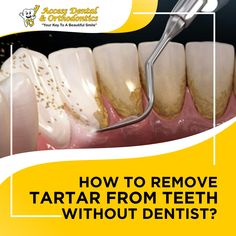 How to Remove Plaque & Tartar From Teeth (Without Dentist) At Home Tartar Removal, Removing Plaque From Teeth, How To Clean Plaque From Teeth, Tartar Removal From Teeth, How To Get Plaque Off Teeth, Peroxide On Teeth, How To Remove Plaque From Teeth At Home, Removing Plaque From Teeth At Home, Diy Plaque Remover Teeth