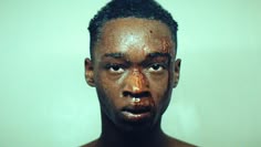 a man with brown spots on his face and nose is looking at the camera while standing in front of a white wall